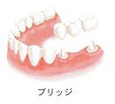 歯を1本失った場合
