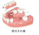 歯を1本失った場合