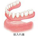 歯を1本失った場合