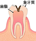 虫歯のはじまり