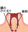 虫歯のはじまり